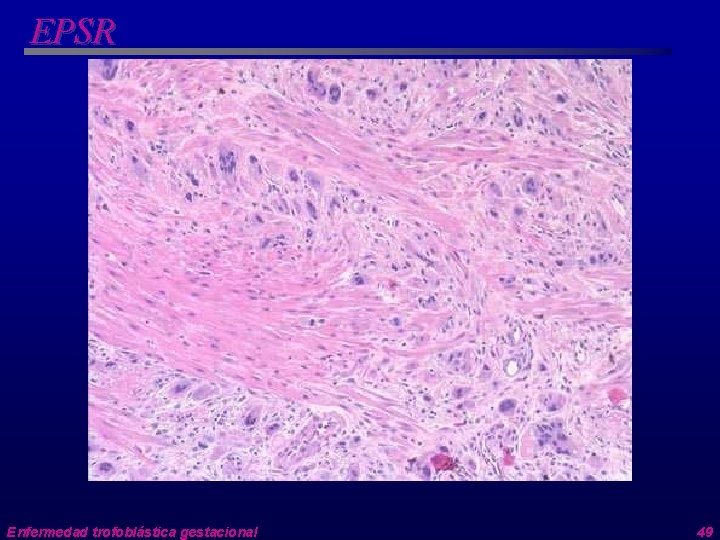 EPSR Enfermedad trofoblástica gestacional 49 