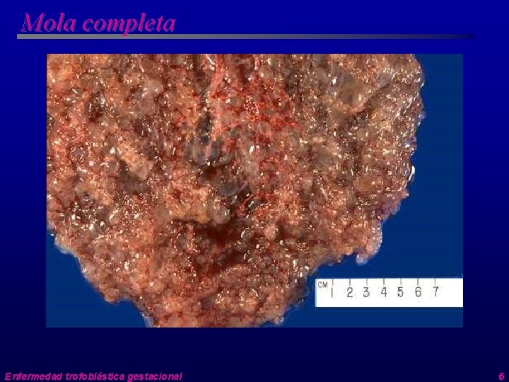 Mola completa Enfermedad trofoblástica gestacional 6 