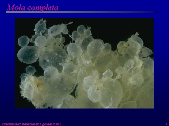 Mola completa Enfermedad trofoblástica gestacional 7 