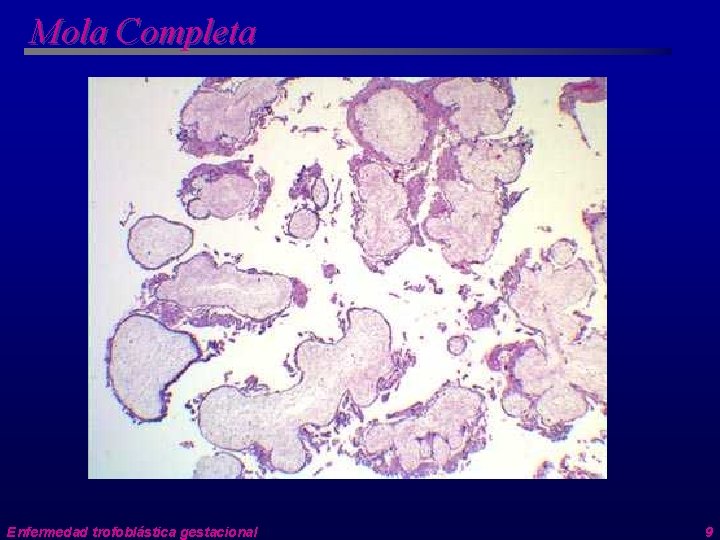 Mola Completa Enfermedad trofoblástica gestacional 9 