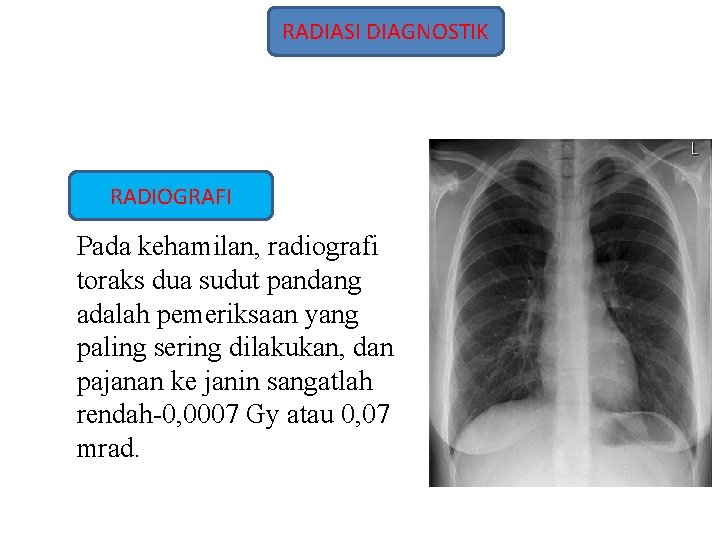 RADIASI DIAGNOSTIK RADIOGRAFI Pada kehamilan, radiografi toraks dua sudut pandang adalah pemeriksaan yang paling