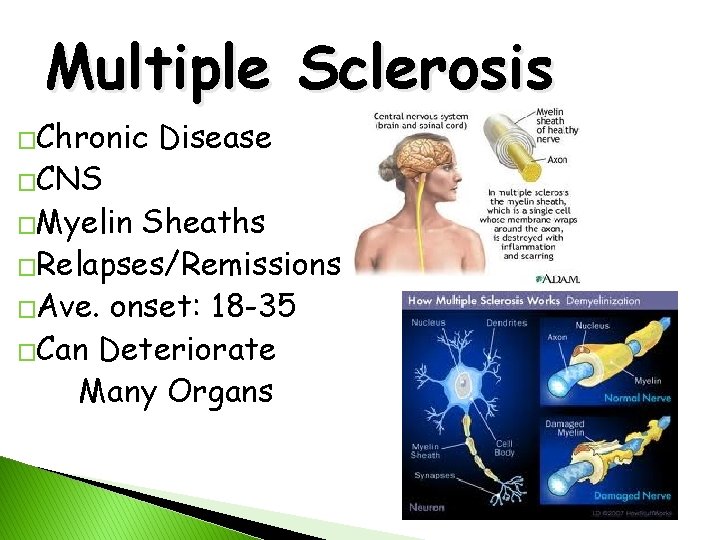 Multiple Sclerosis �Chronic �CNS �Myelin Disease Sheaths �Relapses/Remissions �Ave. onset: 18 -35 �Can Deteriorate