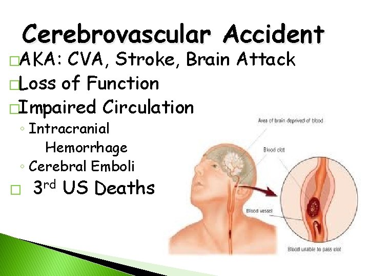 Cerebrovascular Accident �AKA: CVA, Stroke, Brain Attack �Loss of Function �Impaired Circulation ◦ Intracranial