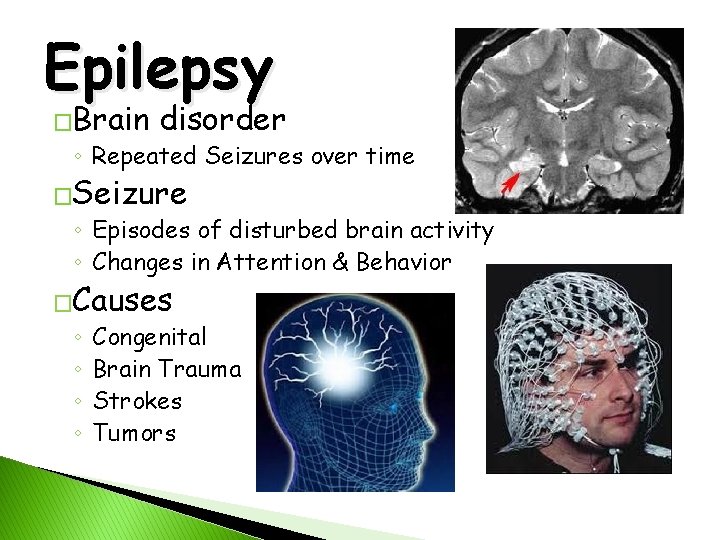 Epilepsy �Brain disorder ◦ Repeated Seizures over time �Seizure ◦ Episodes of disturbed brain
