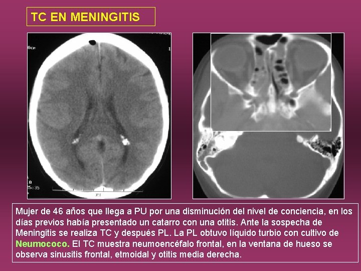 TC EN MENINGITIS Mujer de 46 años que llega a PU por una disminución