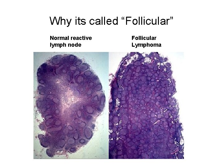 Why its called “Follicular” Normal reactive lymph node Follicular Lymphoma 