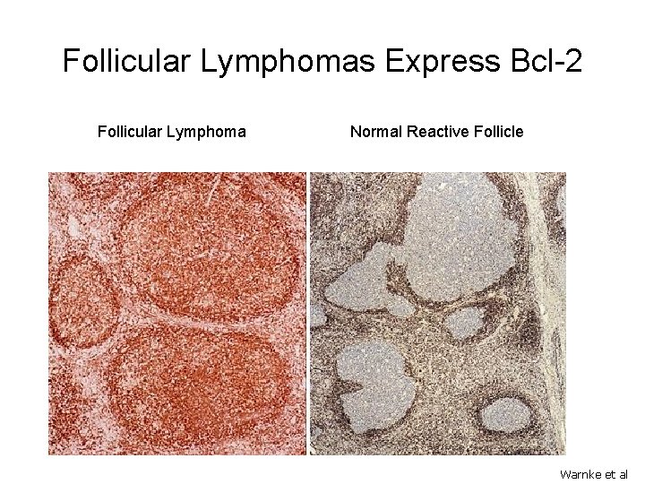 Follicular Lymphomas Express Bcl-2 Follicular Lymphoma Normal Reactive Follicle Warnke et al 