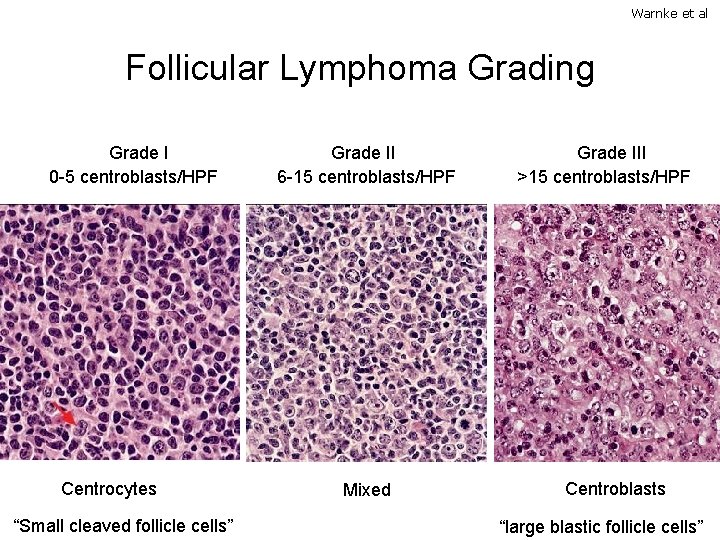 Warnke et al Follicular Lymphoma Grading Grade I 0 -5 centroblasts/HPF Centrocytes “Small cleaved