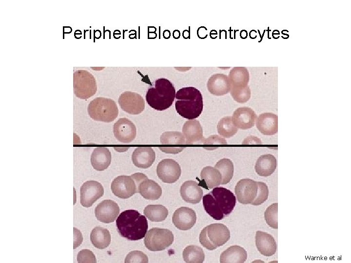 Peripheral Blood Centrocytes Warnke et al 