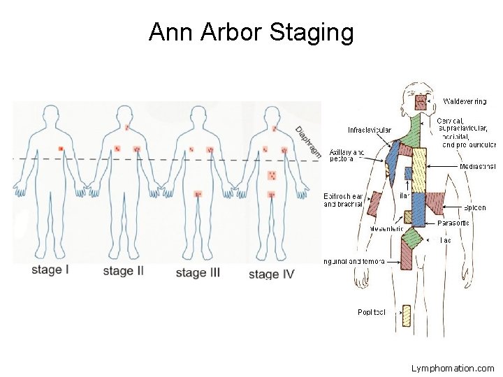 Ann Arbor Staging Lymphomation. com 