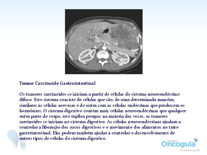 Tumor Carcinoide Gastrointestinal Os tumores carcinoides se iniciam a partir de células do sistema