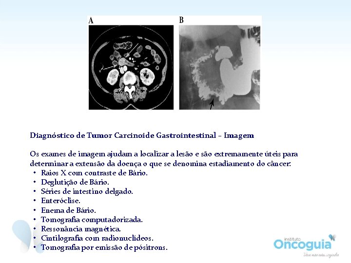 Diagnóstico de Tumor Carcinoide Gastrointestinal – Imagem Os exames de imagem ajudam a localizar