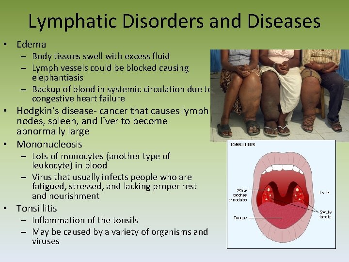 Lymphatic Disorders and Diseases • Edema – Body tissues swell with excess fluid –