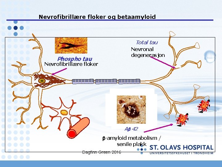 Nevrofibrillære floker og betaamyloid Total tau Nevronal degenerasjon Phospho tau Nevrofibrillære floker Ab 42