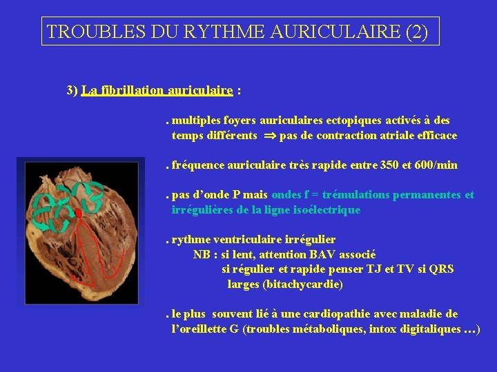 TROUBLES DU RYTHME AURICULAIRE (2) 3) La fibrillation auriculaire : . multiples foyers auriculaires