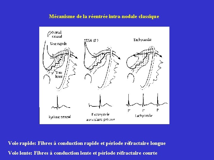 Mécanisme de la réentrée intra-nodale classique Voie rapide: Fibres à conduction rapide et période