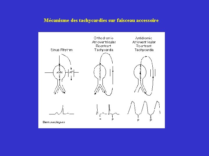 Mécanisme des tachycardies sur faisceau accessoire 