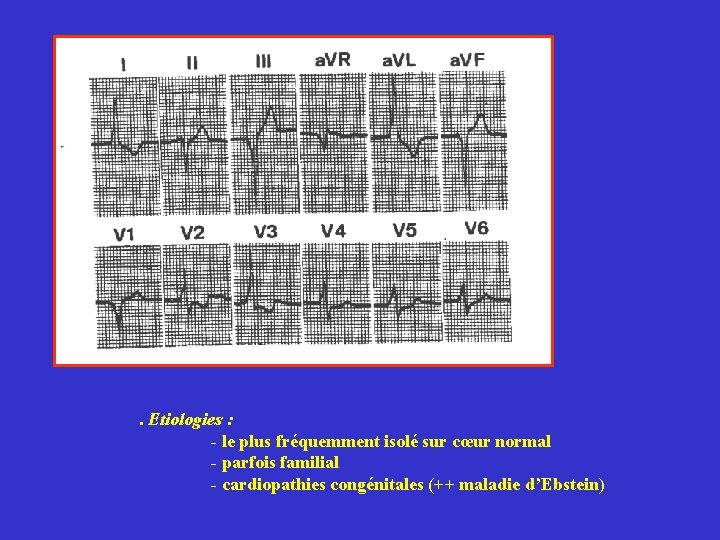 . Etiologies : - le plus fréquemment isolé sur cœur normal - parfois familial