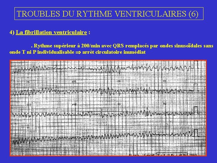 TROUBLES DU RYTHME VENTRICULAIRES (6) 4) La fibrillation ventriculaire : . Rythme supérieur à