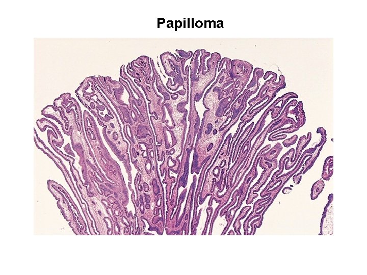 Papilloma 