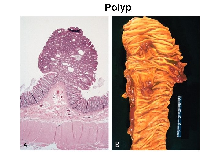 Polyp 