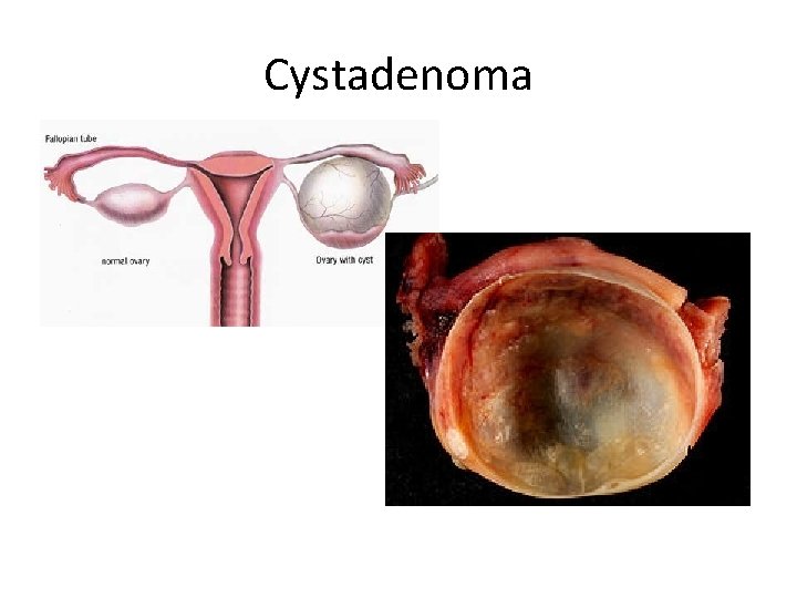 Cystadenoma 