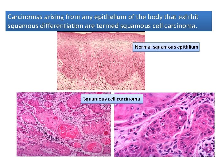 Carcinomas arising from any epithelium of the body that exhibit squamous differentiation are termed