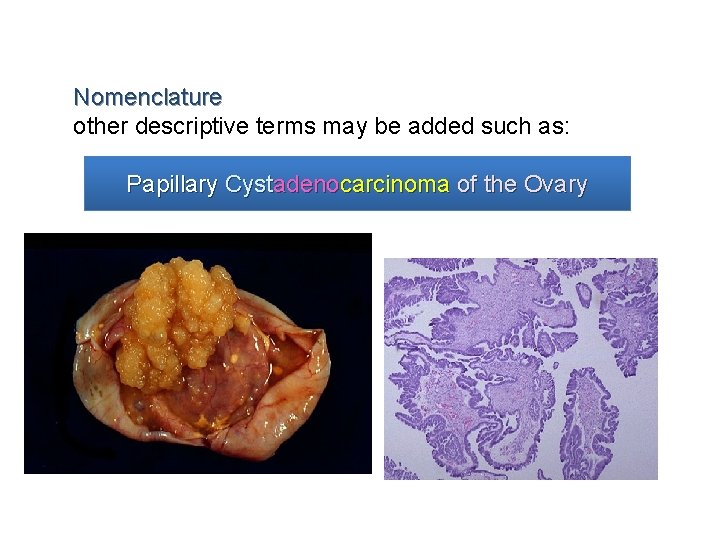 Nomenclature other descriptive terms may be added such as: Papillary Cystadenocarcinoma of the Ovary