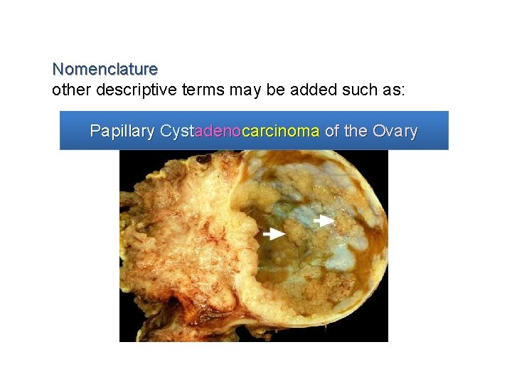 Nomenclature other descriptive terms may be added such as: Papillary Cystadenocarcinoma of the Ovary