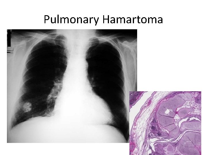 Pulmonary Hamartoma 