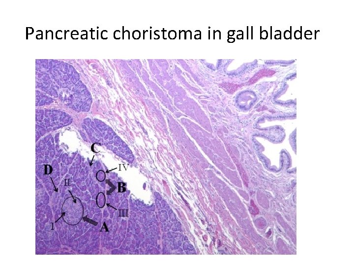 Pancreatic choristoma in gall bladder 