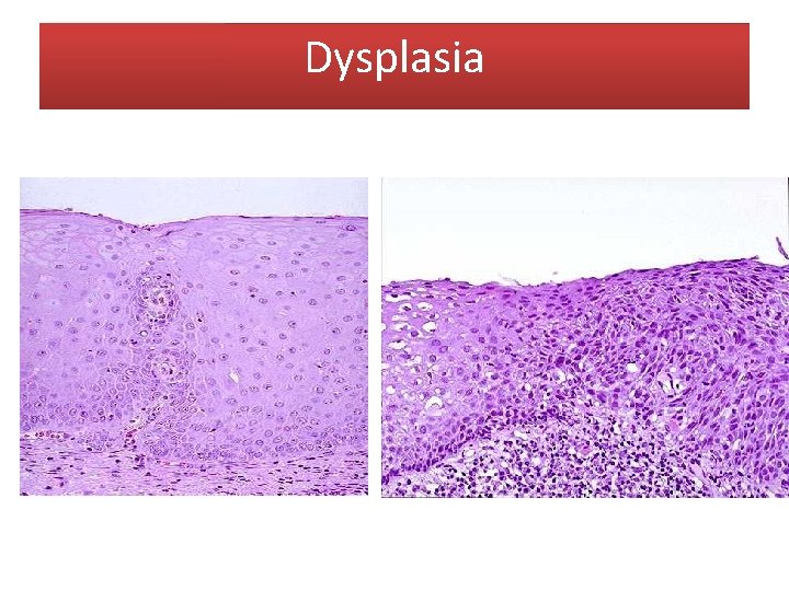 Dysplasia 