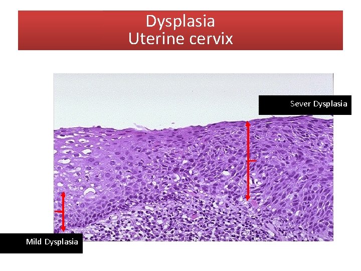 Dysplasia Uterine cervix Sever Dysplasia Mild Dysplasia 
