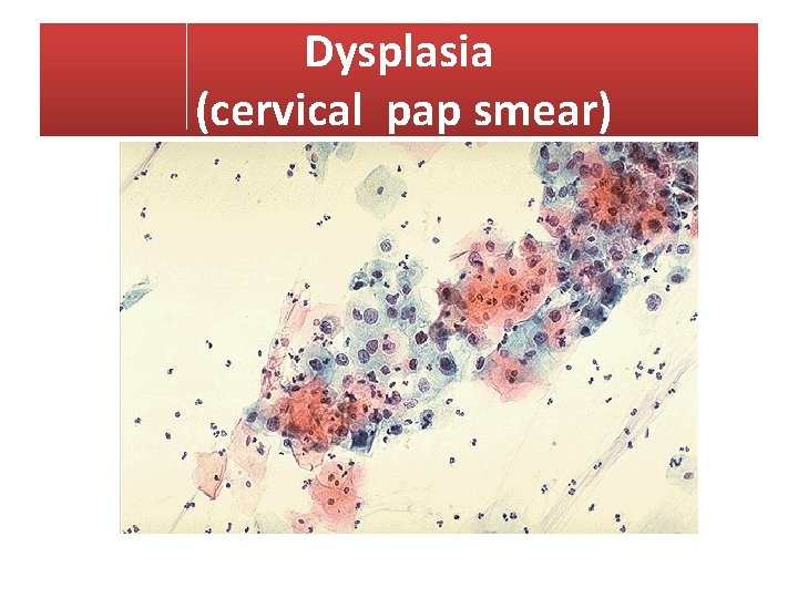 Dysplasia (cervical pap smear) 