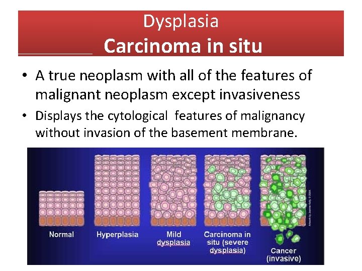 Dysplasia Carcinoma in situ • A true neoplasm with all of the features of