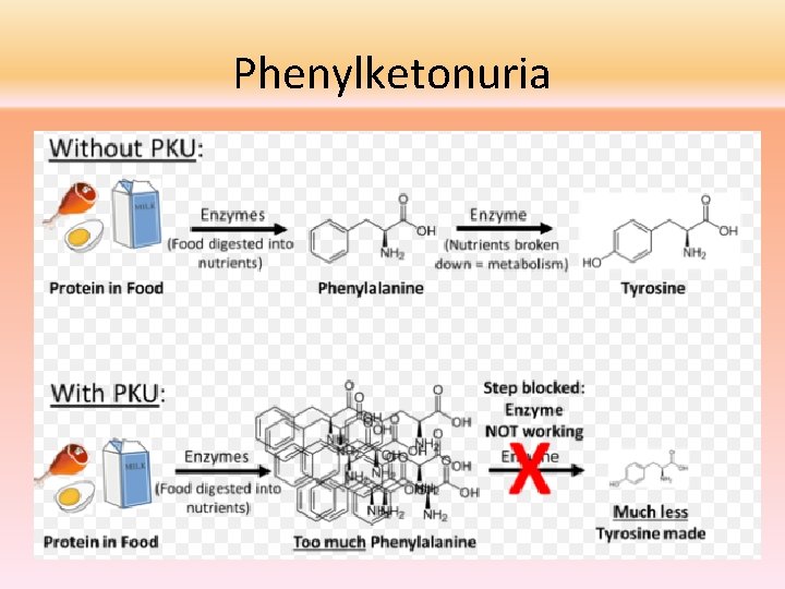 Phenylketonuria 