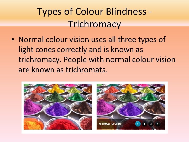 Types of Colour Blindness Trichromacy • Normal colour vision uses all three types of