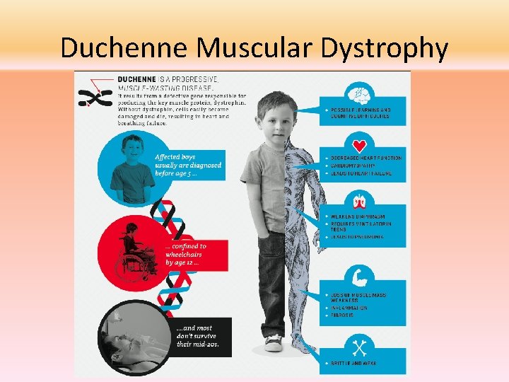 Duchenne Muscular Dystrophy 