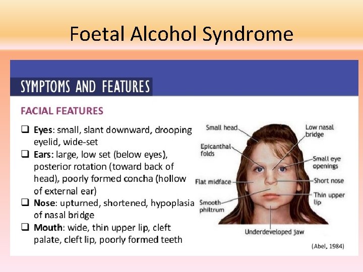 Foetal Alcohol Syndrome 