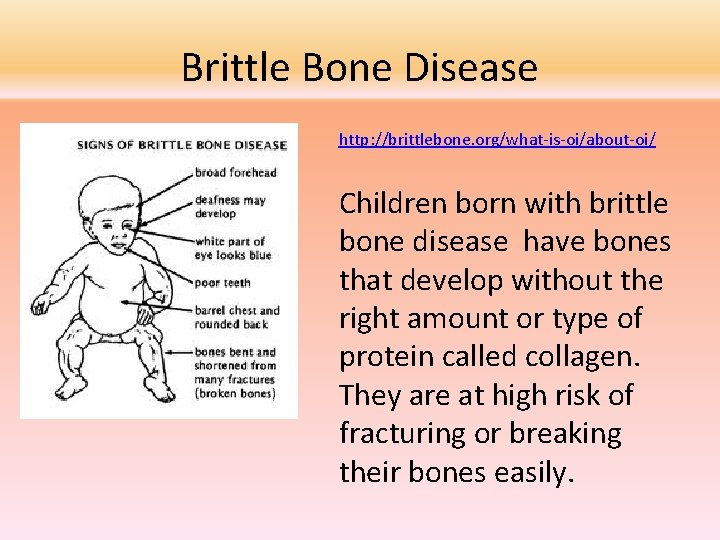 Brittle Bone Disease http: //brittlebone. org/what-is-oi/about-oi/ Children born with brittle bone disease have bones