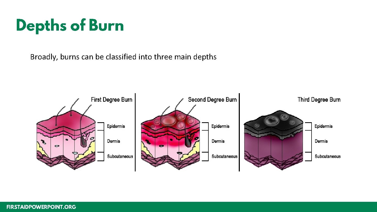 Depths of Burn Broadly, burns can be classified into three main depths FIRSTAIDPOWERPOINT. ORG