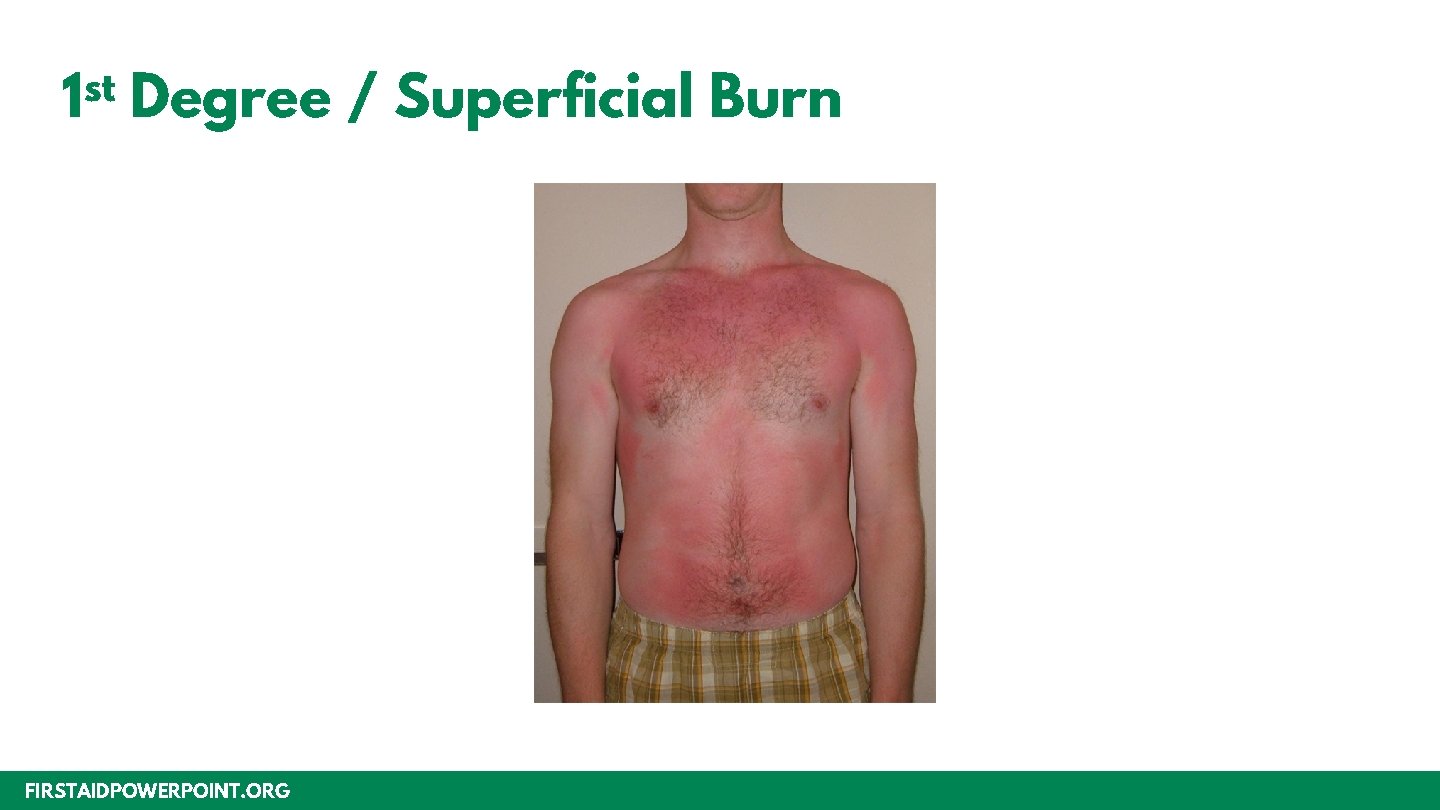 st 1 Degree / Superficial Burn FIRSTAIDPOWERPOINT. ORG 