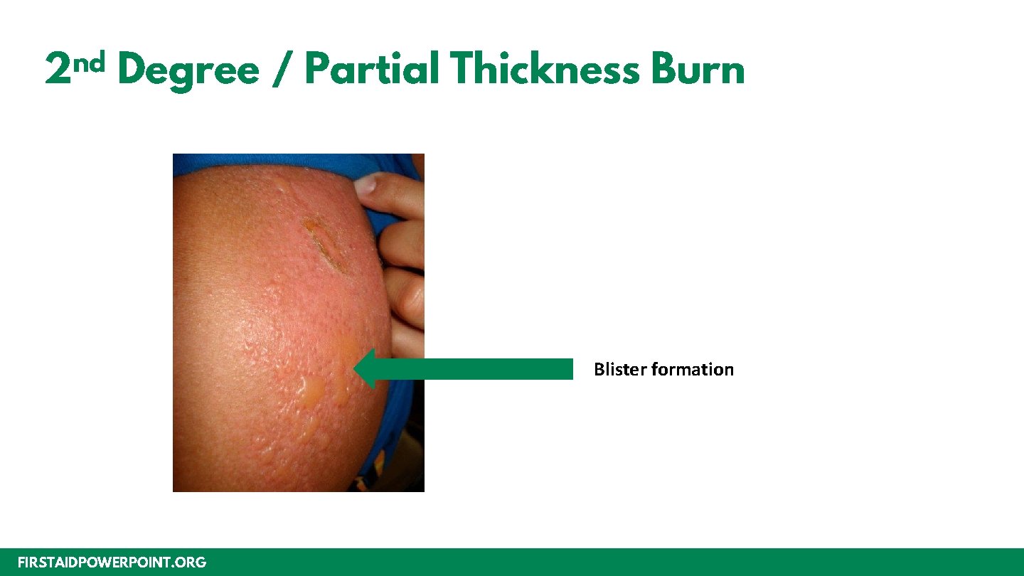 nd 2 Degree / Partial Thickness Burn Blister formation FIRSTAIDPOWERPOINT. ORG 