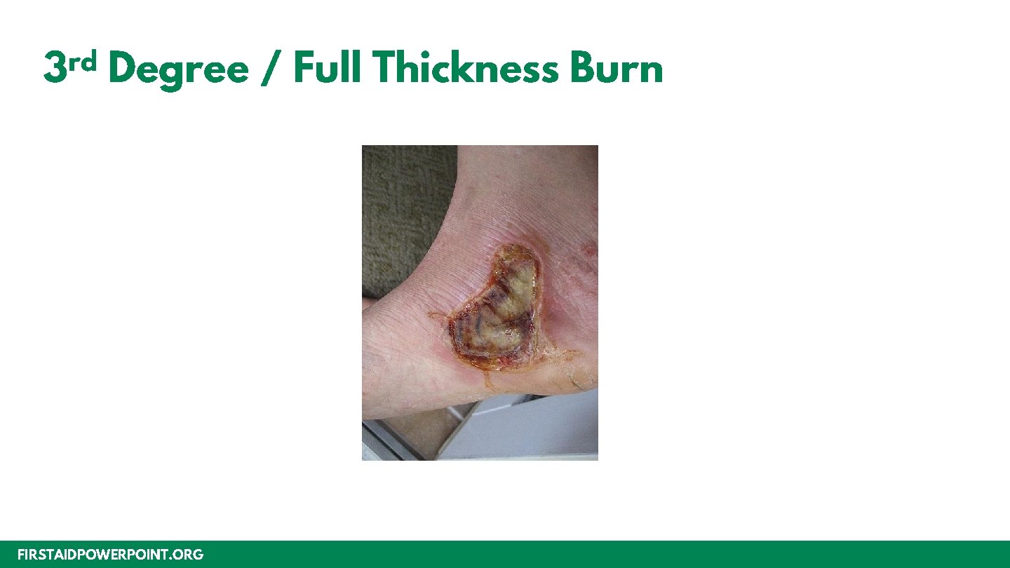rd 3 Degree / Full Thickness Burn FIRSTAIDPOWERPOINT. ORG 
