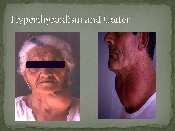 Hyperthyroidism and Goiter 