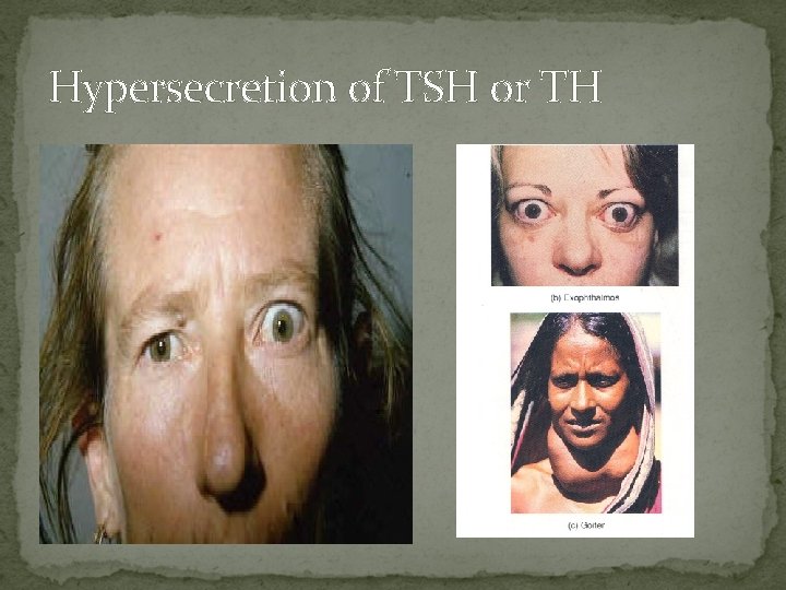 Hypersecretion of TSH or TH 