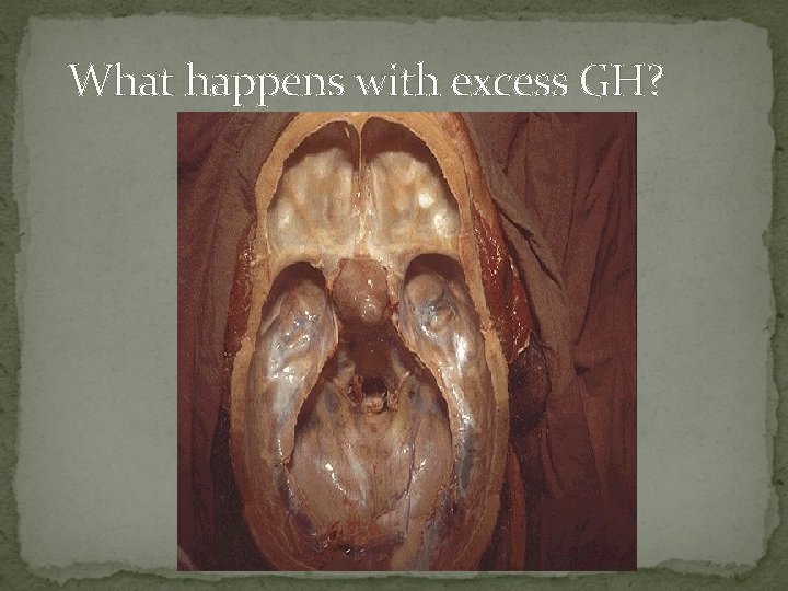 What happens with excess GH? 