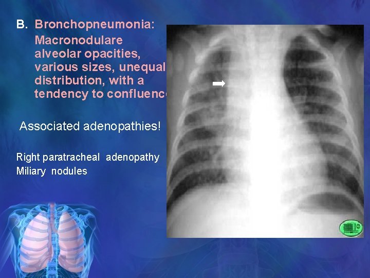 B. Bronchopneumonia: Macronodulare alveolar opacities, various sizes, unequal distribution, with a tendency to confluence
