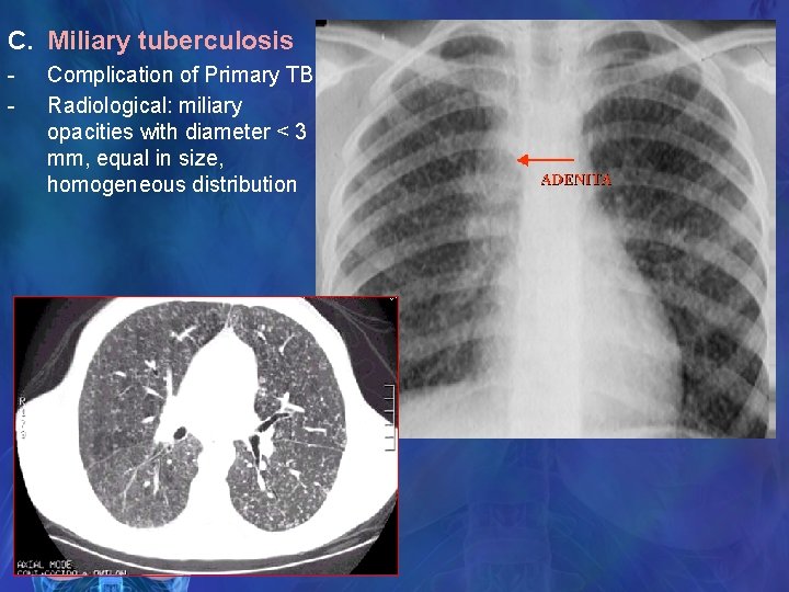 C. Miliary tuberculosis - Complication of Primary TB Radiological: miliary opacities with diameter <