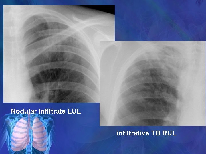 Nodular infiltrate LUL infiltrative TB RUL 